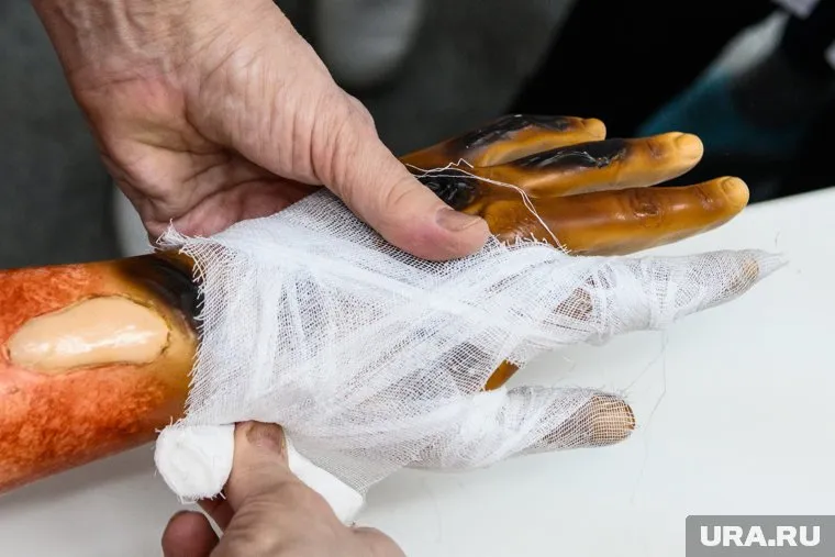 Подросток получил ожоги третьей степени тяжести