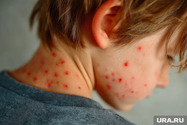 Эпидемия ветрянки обрушилась на Россию в октябре