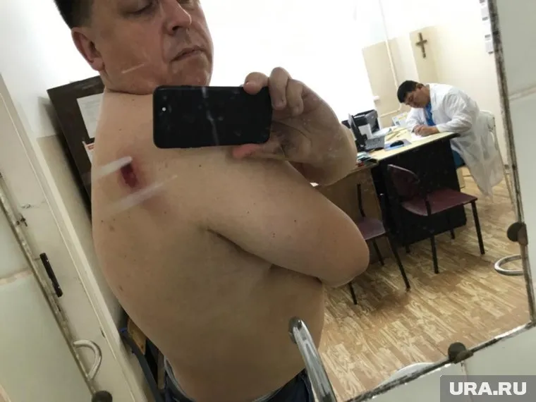 Пуля прошла по касательной по лопатке