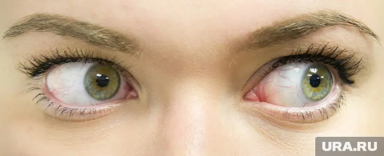 Наблюдение за солнечным затмением без фильтров может привести к частичной или полной потере зрения