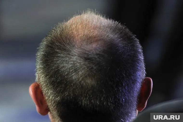 Волосы могут начать выпадать в любом возрасте