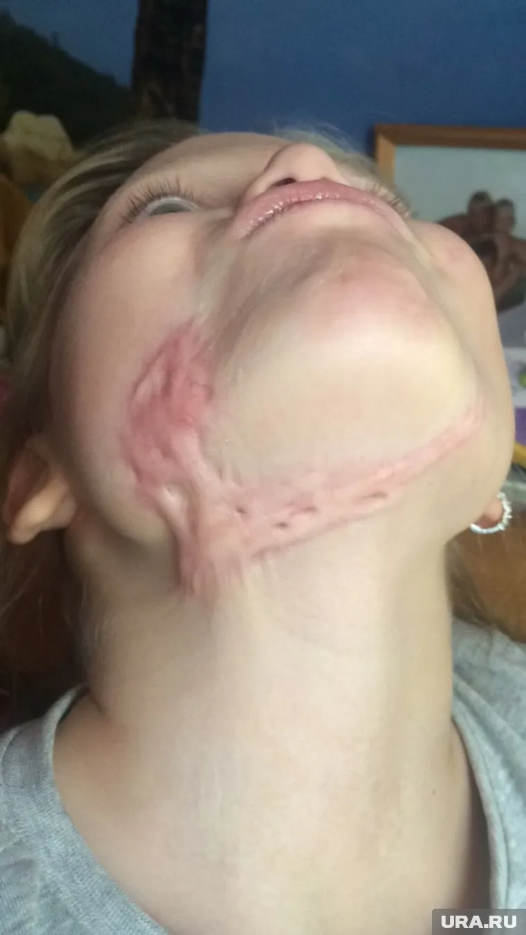 Дети вынуждены жить со страшными шрамами