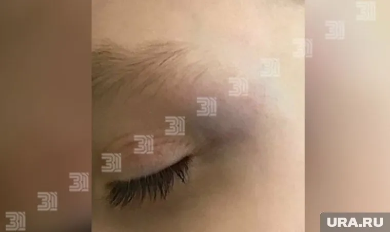 У ребенка большой синяк на голове