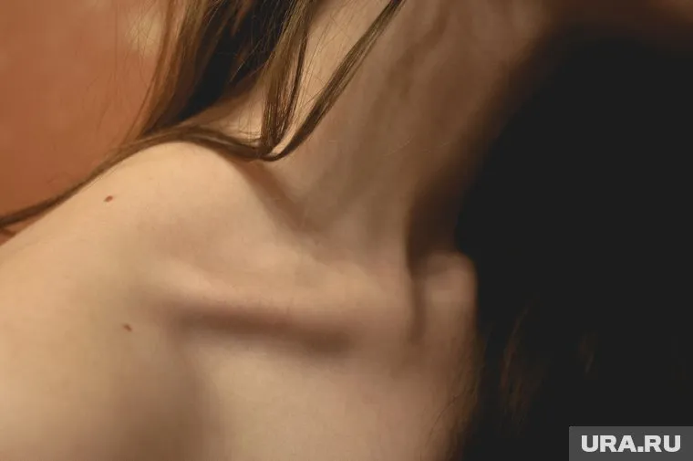 В зоне риска развития меланомы находятся люди со светлой кожей, заявила дерматолог