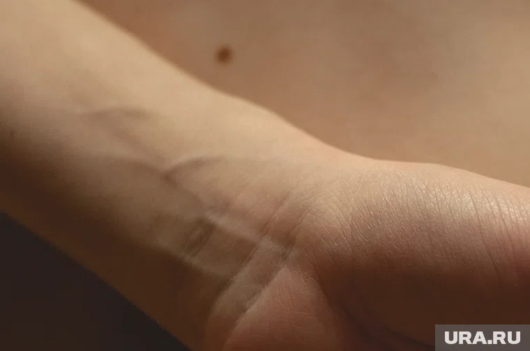 Необходимо следить за цветом родинок, их границами, размером.