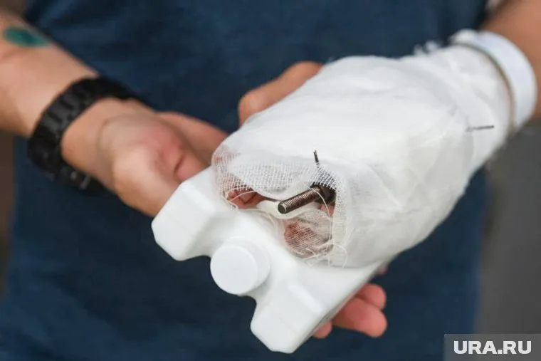 Во время драки Алексею раздробили палец