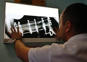 В Кургане создали уникальные титановые имплантаты для восстановления костей