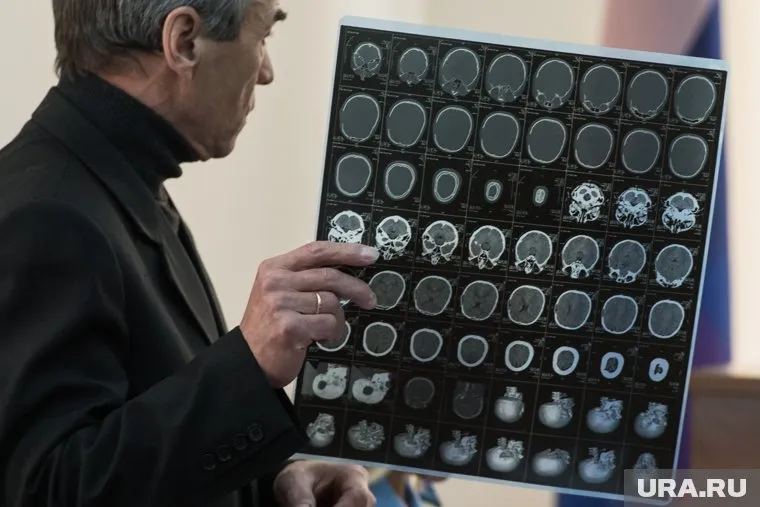 COVID-19 может вызывать поражения головного мозга