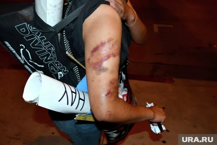 Самая распространенная причина появления гематомы — механическая травма в форме ушиба