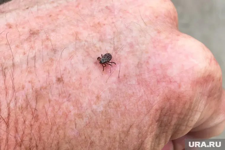 Мужчина умер, заразившись энцефалитом от клеща