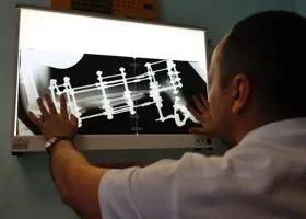 Жительницу ДНР с висящей на сухожилии стопой спас курганский аппарат Илизарова