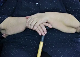 Более 20% россиян оказались предрасположены к ожирению из-за мутации